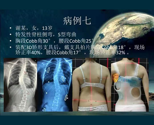 脊柱側彎矯案例 (11)