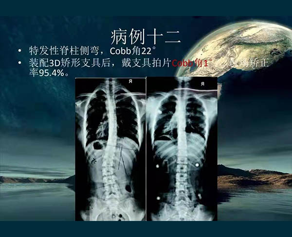 脊柱側彎矯案例 (6)