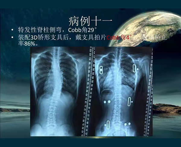 脊柱側彎矯案例 (5)