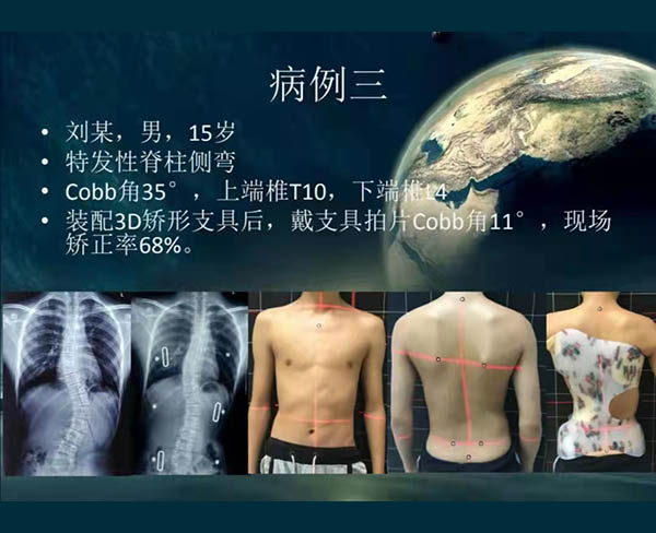 脊柱側彎矯案例 (9)