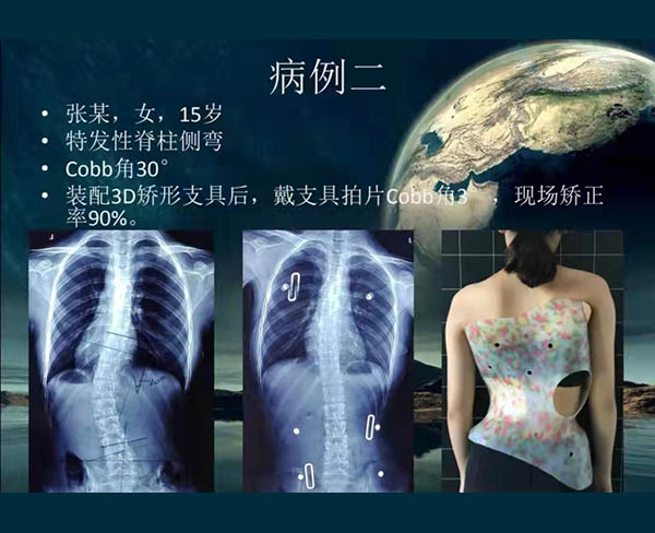 脊柱側彎矯案例 (2)