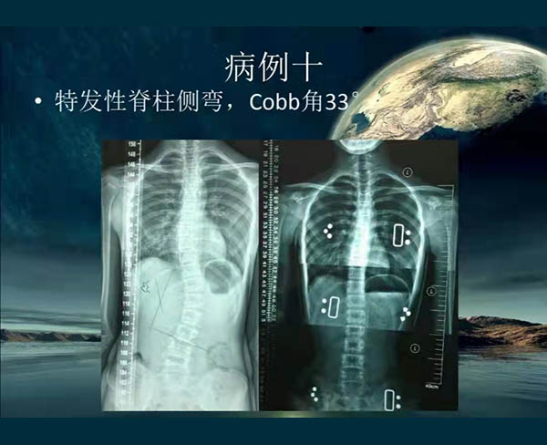 脊柱側彎矯案例 (4)