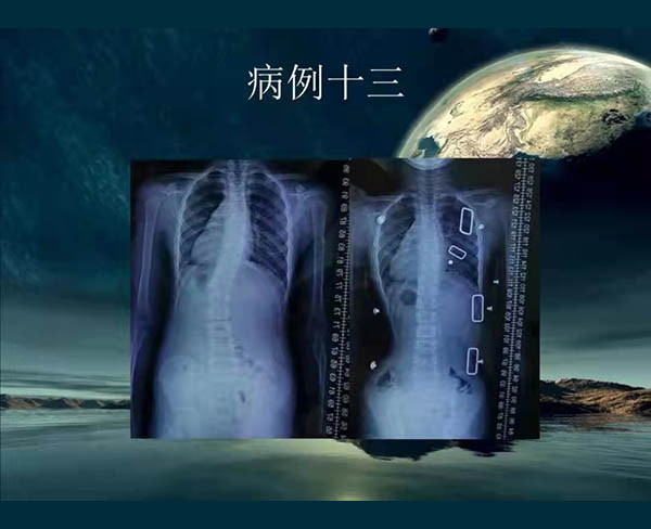 脊柱側彎矯案例 (3)