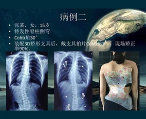 脊柱側彎矯案例 (2)