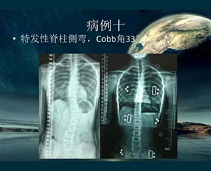 脊柱側彎矯案例 (4)