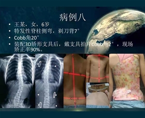 脊柱側彎矯案例 (1)